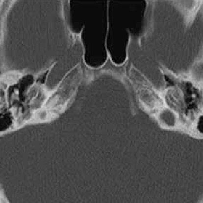  Osseointegration의 놀라움! 탈회 심한 환자도 기뻐할 오스테오인덕티브 하이드록시아파타이트 (Osteoinductive Hydroxyapatite)의 모든 것